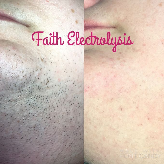 Female client who shaved her neck and chin for 20 years. These are the results after 3 months of treatments.