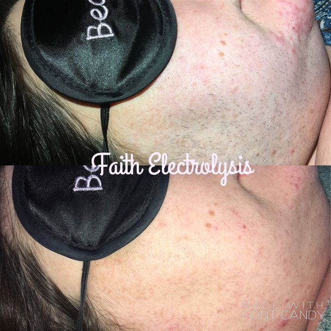 The side face of a lady who shaved for 20 years. These are the results after 3 months of Electrolysis treatments.