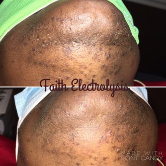 Clients chin and neck after 2 months of treatments. If you zoom in, you can see how much thinner and how sparse the hairs have become after only 2 months!