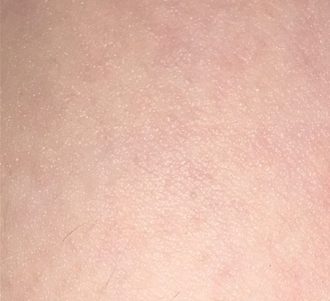 Armpits after 2 treatments, a span of 3-1/2 months.