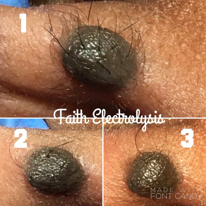 Mole after 3 treatments. 6 months span between image 1 & 3.