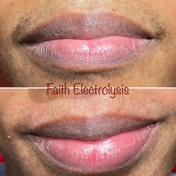Upper lips before and directly right after treatment. You can see there is hardly any redness at all.